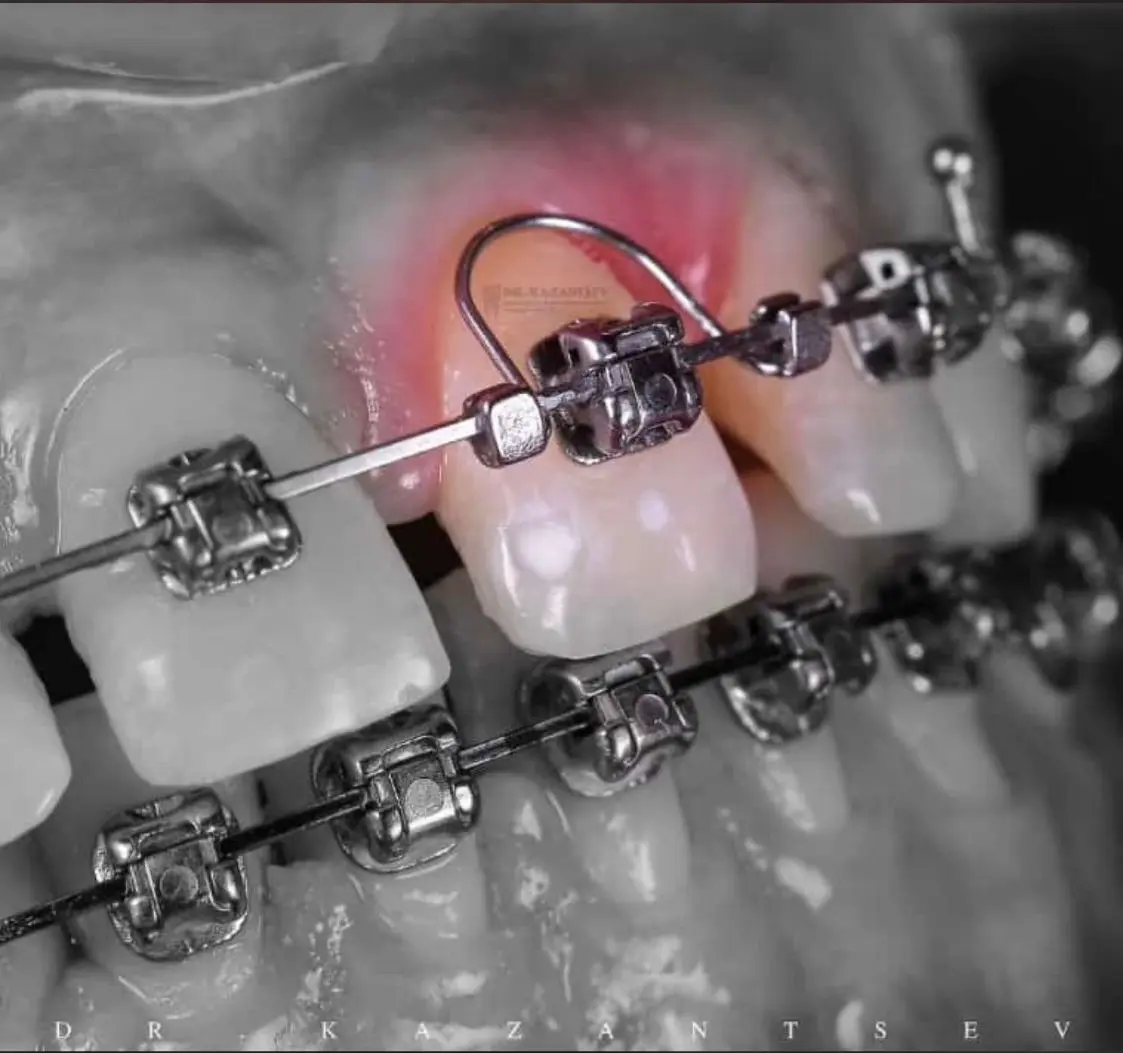 Insumos de ortodoncia