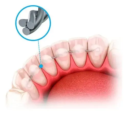 Varillas de Contención TwistForm 3x3 -0,50mm Morelli X10u